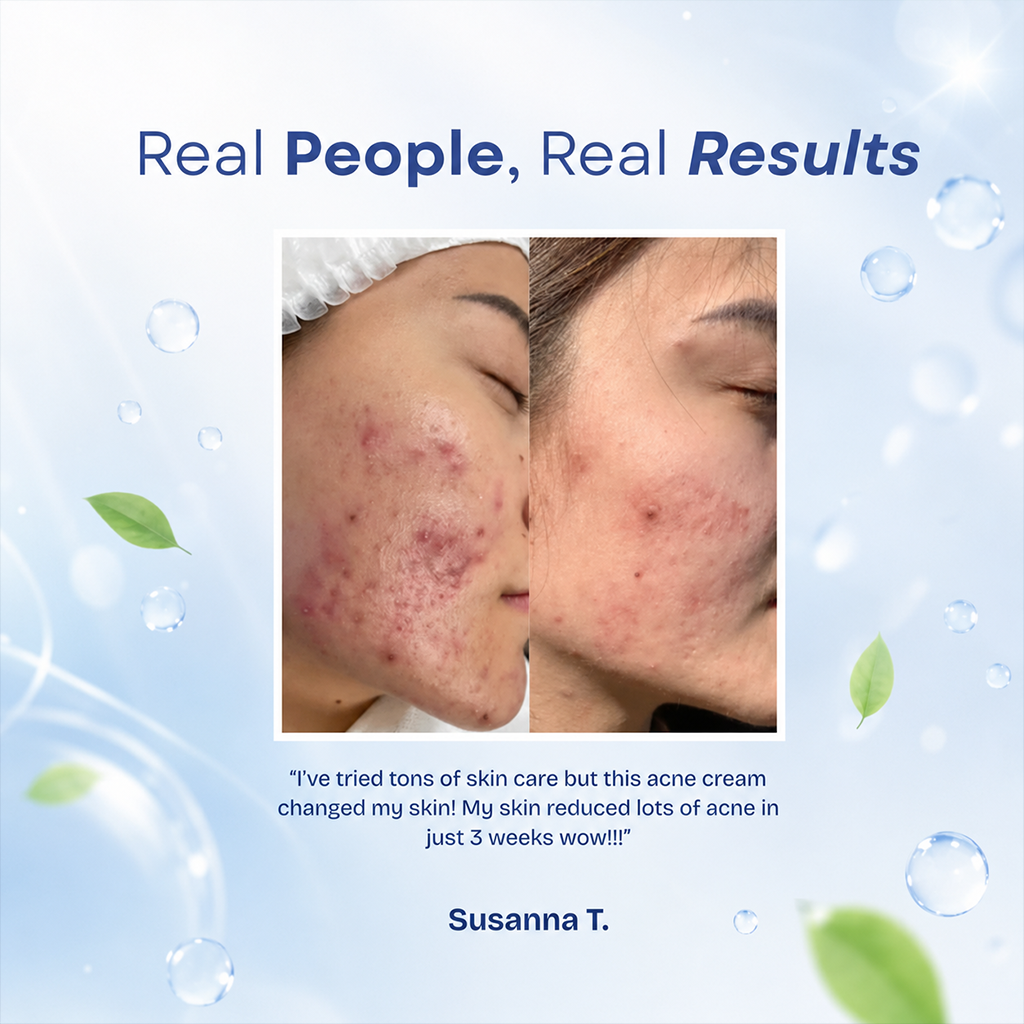 Acne Treatment-Pimples Removal Cream Pair