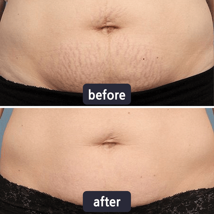 Viralaluna Scar Removal Cream